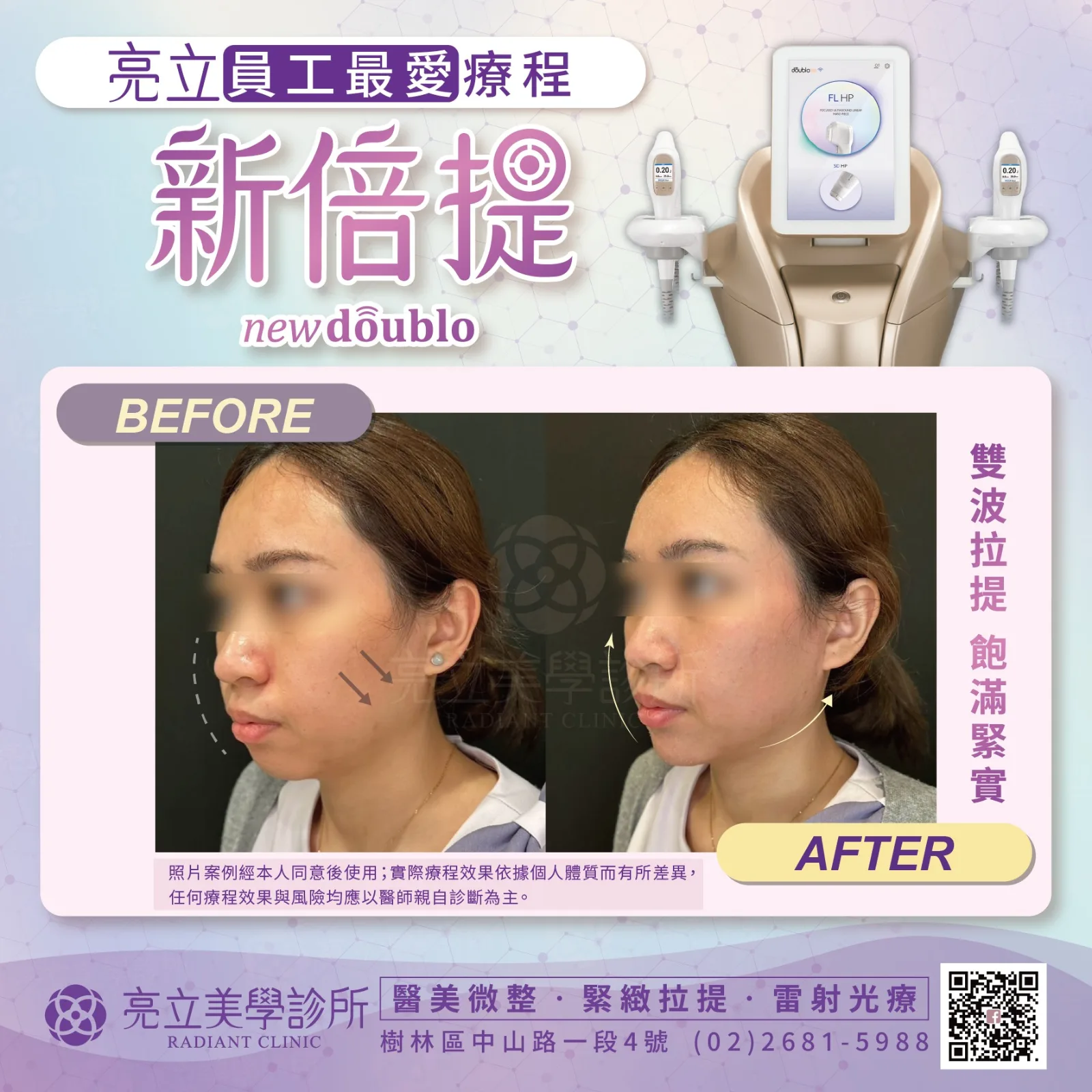 音波拉提 — 輪廓緊緻