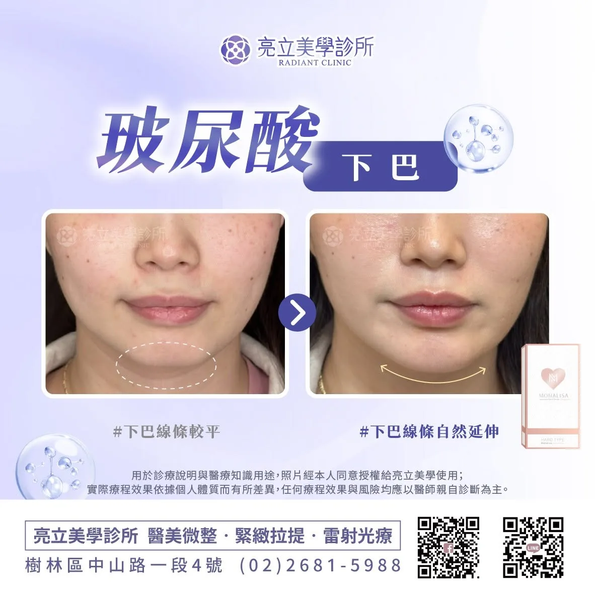 玻尿酸－下巴線條自然延伸