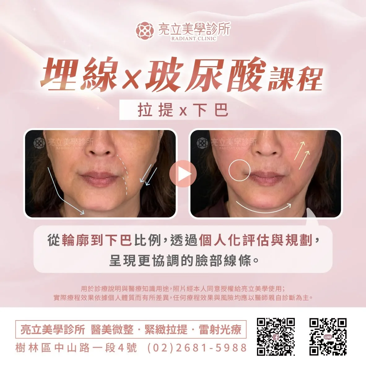 埋線×玻尿酸課程