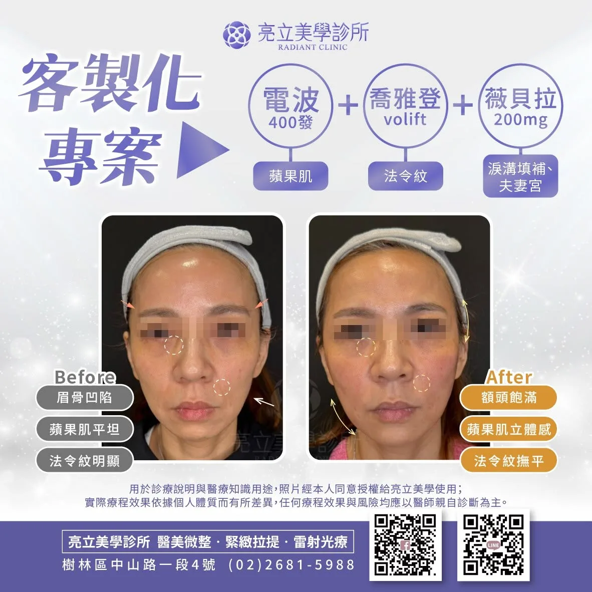 客製化專案－電波+喬雅登+薇貝拉