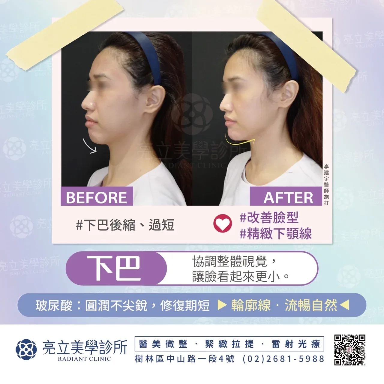 玻尿酸填充 — 輪廓線流暢自然